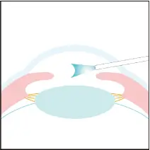レンズ挿入イメージ