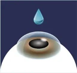 点眼麻酔イメージ