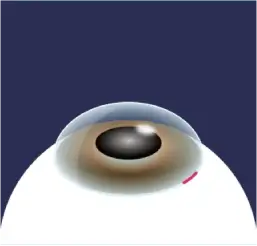 切開イメージ